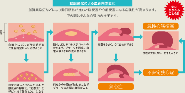 動脈硬化による血管内の変化