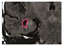 正常な状態の脳の海馬