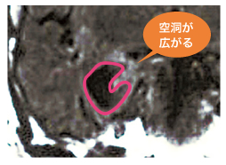 アルツハイマー型認知症の脳の海馬