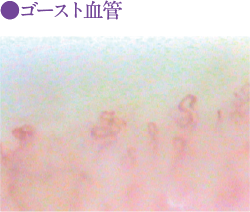ゴースト血管