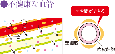 不健康な血管