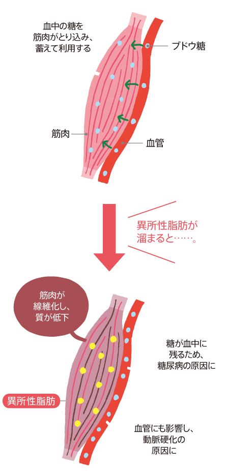 筋肉に溜まった異所性脂肪