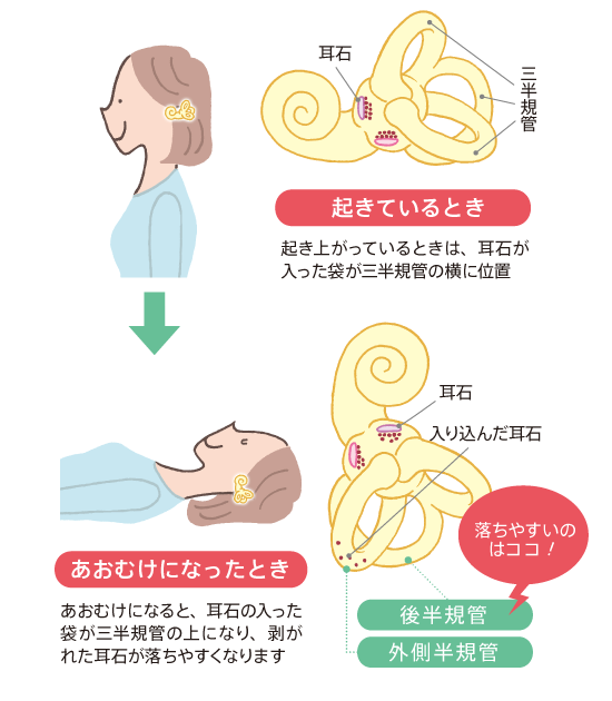 耳石が落ちやすい位置