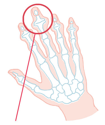へバーデン結節