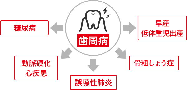 歯周病 糖尿病 動脈硬化 心疾患 誤嚥性肺炎 骨粗しょう症 早産 低体重児出産