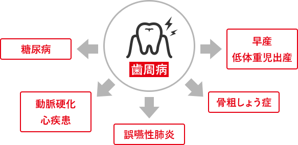 歯周病 糖尿病 動脈硬化 心疾患 誤嚥性肺炎 骨粗しょう症 早産 低体重児出産