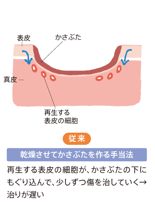 乾燥させてかさぶたを作る手当法