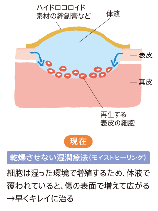 乾燥させない湿潤療法